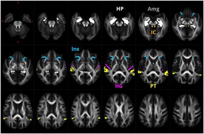 The effect of aging, hearing loss, and tinnitus on white matter in the human auditory system revealed with fixel-based analysis